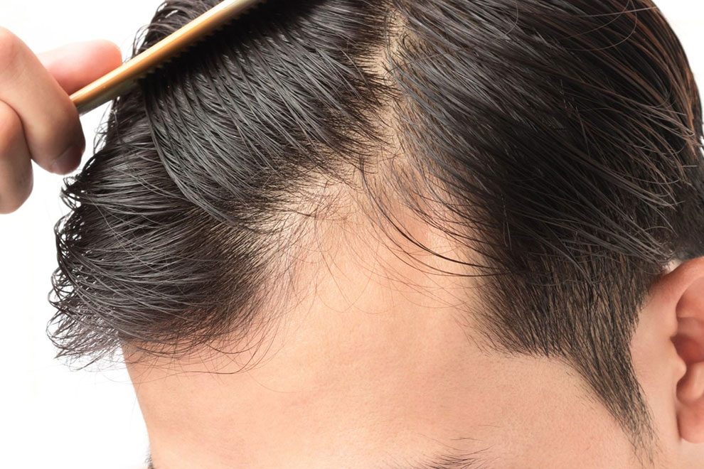 erkeklerde saç dökülmesi